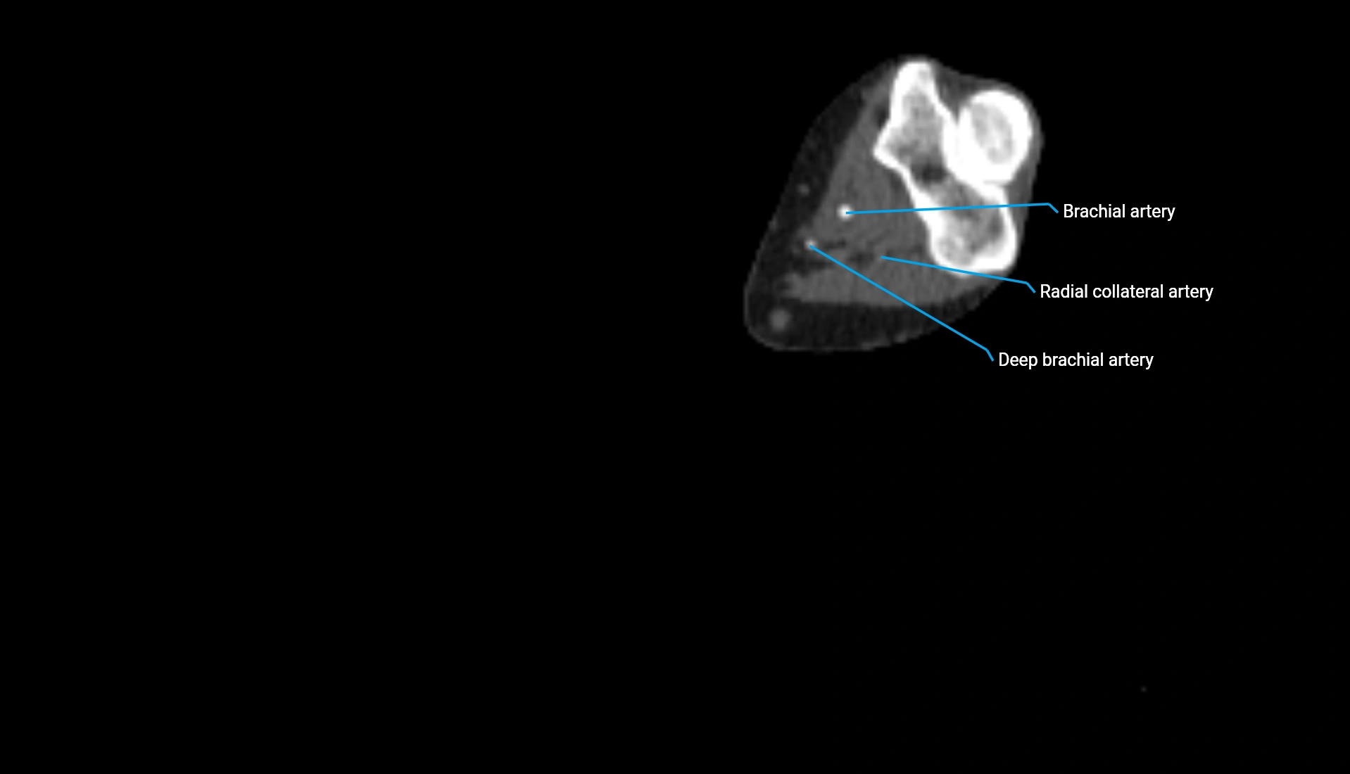 CTA upper limb axial cross sectional anatomy labelled image 191 (2).webp